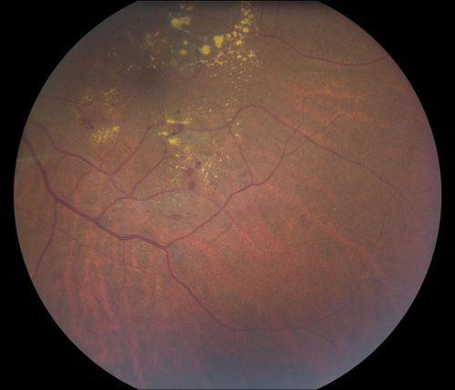 Nonproliferative Diabetic Retinopathy
65-year old female with diabetes. Has had cataract surgery in the left eye with VA 20/25. She has had laser in the past. Fundus examination shows microaneurysms with retinal hemorrahages and exudates in the left eye. 
