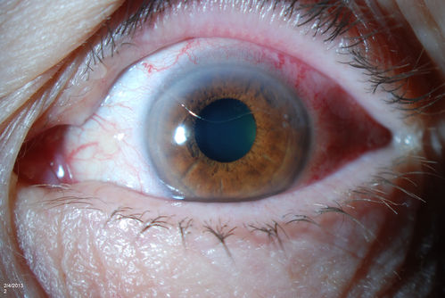 Corneal Abrasion with Foreign Body Present 
ER patient comes in with corneal abrasion in the left eye which was getting worst. VA 20/25. Slit lamp exam showed corneal abrasion superiorly at 2-o'clock. Flipped eyelid and foreign body appeared on the upper tarsal plate. Foreign body was removed. 
