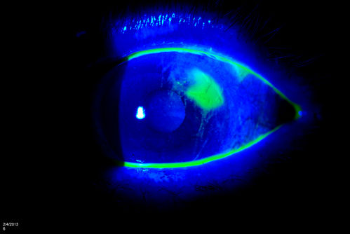 Corneal Abrasion with Foreign Body Present 
ER patient comes in with corneal abrasion in the left eye which was getting worst. VA 20/25. Slit lamp exam showed corneal abrasion superiorly at 2-o'clock. Flipped eyelid and foreign body appeared on the upper tarsal plate. Foreign body was removed. 
Keywords: february2013