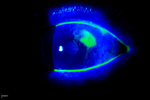 Corneal Abrasion with Foreign Body Present 
ER patient comes in with corneal abrasion in the left eye which was getting worst. VA 20/25. Slit lamp exam showed corneal abrasion superiorly at 2-o'clock. Flipped eyelid and foreign body appeared on the upper tarsal plate. Foreign body was removed. 

