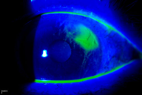Corneal Abrasion with Foreign Body Present 
ER patient comes in with corneal abrasion in the left eye which was getting worst. VA 20/25. Slit lamp exam showed corneal abrasion superiorly at 2-o'clock. Flipped eyelid and foreign body appeared on the upper tarsal plate. Foreign body was removed. 
