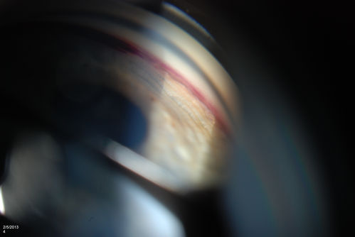 Gonioscopy, Blood in the Anterior Chamber from Hyphema
Patient comes in with blunt trauma to the right eye due to a BB gun incident. Patient was present with a hyphema at 8-o'clock about 1mm thick. Gonioscopy photos were then taken to show blood from the hyphema entered into the anterior chamber. Patient had no angle recession in the right eye.  
