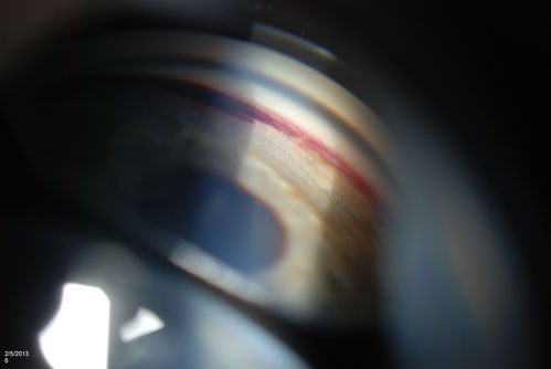 Gonioscopy, Blood in the Anterior Chamber from Hyphema
Patient comes in with blunt trauma to the right eye due to a BB gun incident. Patient was present with a hyphema at 8-o'clock about 1mm thick. Gonioscopy photos were then taken to show blood from the hyphema entered into the anterior chamber. Patient had no angle recession in the right eye.  

