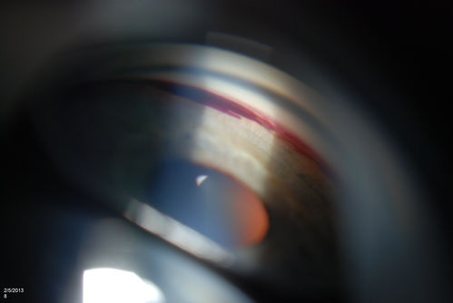 Gonioscopy, Blood in the Anterior Chamber from Hyphema
Patient comes in with blunt trauma to the right eye due to a BB gun incident. Patient was present with a hyphema at 8-o'clock about 1mm thick. Gonioscopy photos were then taken to show blood from the hyphema entered into the anterior chamber. Patient had no angle recession in the right eye.  

