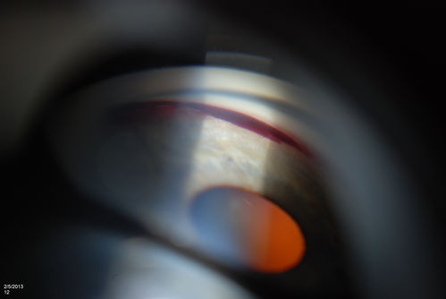 Gonioscopy, Blood in the Anterior Chamber from Hyphema
Patient comes in with blunt trauma to the right eye due to a BB gun incident. Patient was present with a hyphema at 8-o'clock about 1mm thick. Gonioscopy photos were then taken to show blood from the hyphema entered into the anterior chamber. Patient had no angle recession in the right eye.  
