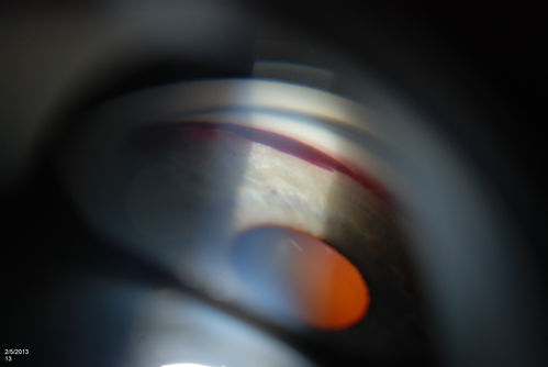 Gonioscopy, Blood in the Anterior Chamber from Hyphema
Patient comes in with blunt trauma to the right eye due to a BB gun incident. Patient was present with a hyphema at 8-o'clock about 1mm thick. Gonioscopy photos were then taken to show blood from the hyphema entered into the anterior chamber. Patient had no angle recession in the right eye.  
