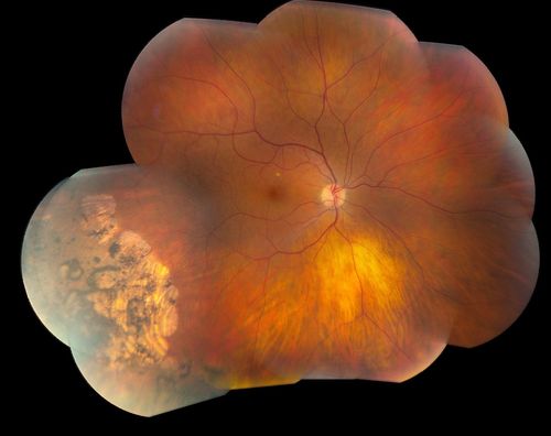 Pigmented Peripheral Retinal Degeneration
42-year old male comes in for routine eye exam and to follow up on peripheral retinal degeneration in both eyes. VA is 20/20, right eye and 20/25, left eye. Patient is asymptomatic with no visual complaints.
