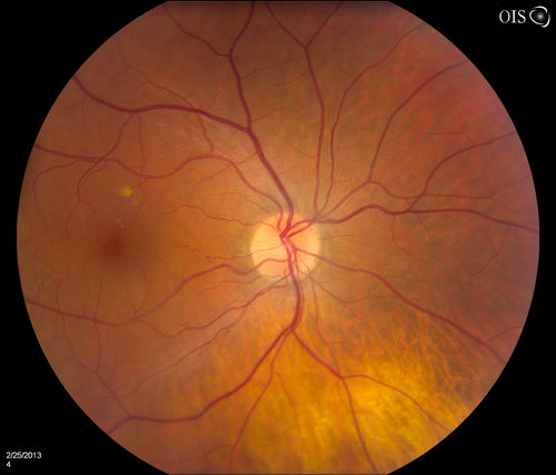 Pigmented Peripheral Retinal Degeneration
42-year old male comes in for routine eye exam and to follow up on peripheral retinal degeneration in both eyes. VA is 20/20, right eye and 20/25, left eye. Patient is asymptomatic with no visual complaints.
