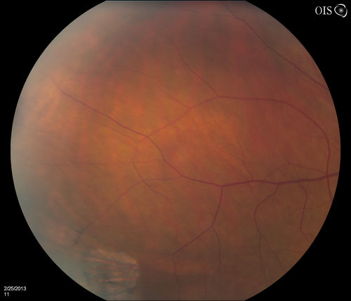 Pigmented Peripheral Retinal Degeneration
42-year old male comes in for routine eye exam and to follow up on peripheral retinal degeneration in both eyes. VA is 20/20, right eye and 20/25, left eye. Patient is asymptomatic with no visual complaints.
