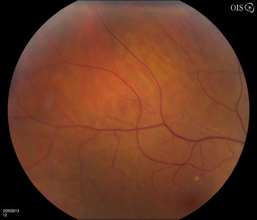 Pigmented Peripheral Retinal Degeneration
42-year old male comes in for routine eye exam and to follow up on peripheral retinal degeneration in both eyes. VA is 20/20, right eye and 20/25, left eye. Patient is asymptomatic with no visual complaints.

