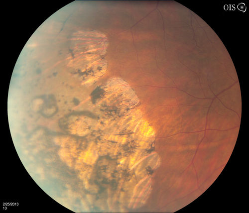 Pigmented Peripheral Retinal Degeneration
42-year old male comes in for routine eye exam and to follow up on peripheral retinal degeneration in both eyes. VA is 20/20, right eye and 20/25, left eye. Patient is asymptomatic with no visual complaints.
