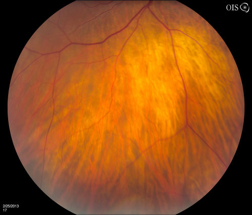 Pigmented Peripheral Retinal Degeneration
42-year old male comes in for routine eye exam and to follow up on peripheral retinal degeneration in both eyes. VA is 20/20, right eye and 20/25, left eye. Patient is asymptomatic with no visual complaints.
