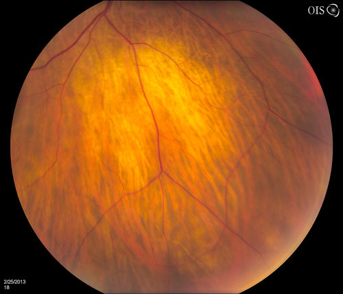 Pigmented Peripheral Retinal Degeneration
42-year old male comes in for routine eye exam and to follow up on peripheral retinal degeneration in both eyes. VA is 20/20, right eye and 20/25, left eye. Patient is asymptomatic with no visual complaints.
