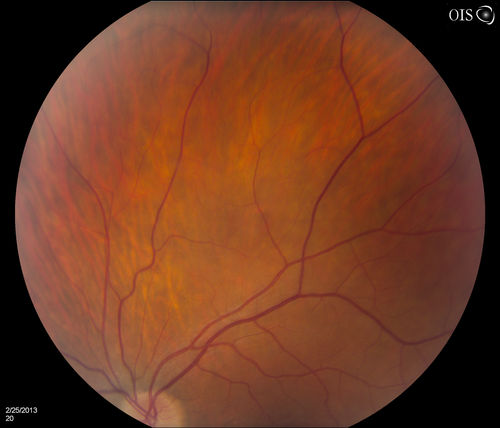 Pigmented Peripheral Retinal Degeneration
42-year old male comes in for routine eye exam and to follow up on peripheral retinal degeneration in both eyes. VA is 20/20, right eye and 20/25, left eye. Patient is asymptomatic with no visual complaints.
