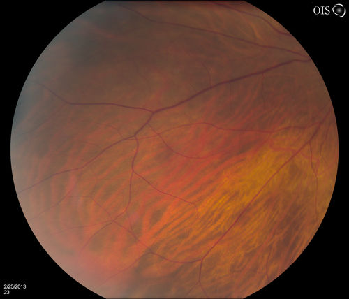 Pigmented Peripheral Retinal Degeneration
42-year old male comes in for routine eye exam and to follow up on peripheral retinal degeneration in both eyes. VA is 20/20, right eye and 20/25, left eye. Patient is asymptomatic with no visual complaints.
