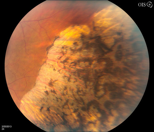 Pigmented Peripheral Retinal Degeneration
42-year old male comes in for routine eye exam and to follow up on peripheral retinal degeneration in both eyes. VA is 20/20, right eye and 20/25, left eye. Patient is asymptomatic with no visual complaints.
