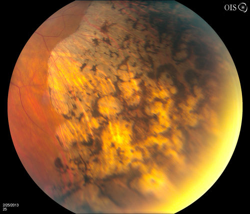 Pigmented Peripheral Retinal Degeneration
42-year old male comes in for routine eye exam and to follow up on peripheral retinal degeneration in both eyes. VA is 20/20, right eye and 20/25, left eye. Patient is asymptomatic with no visual complaints.
Keywords: february2012