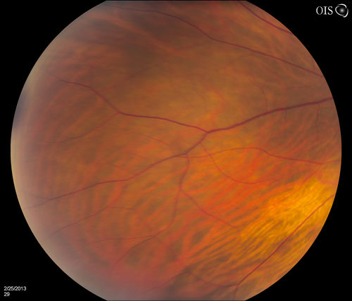 Pigmented Peripheral Retinal Degeneration
42-year old male comes in for routine eye exam and to follow up on peripheral retinal degeneration in both eyes. VA is 20/20, right eye and 20/25, left eye. Patient is asymptomatic with no visual complaints.
