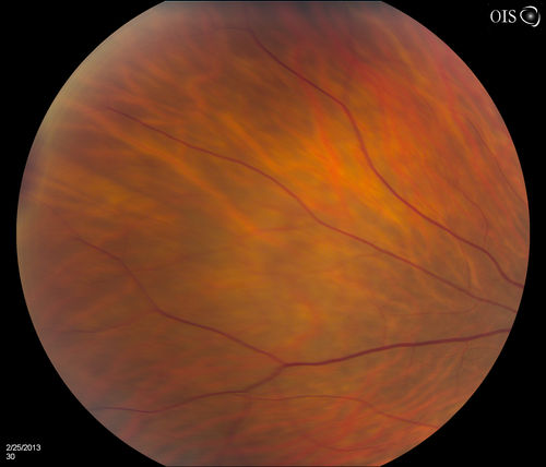 Pigmented Peripheral Retinal Degeneration
42-year old male comes in for routine eye exam and to follow up on peripheral retinal degeneration in both eyes. VA is 20/20, right eye and 20/25, left eye. Patient is asymptomatic with no visual complaints.
