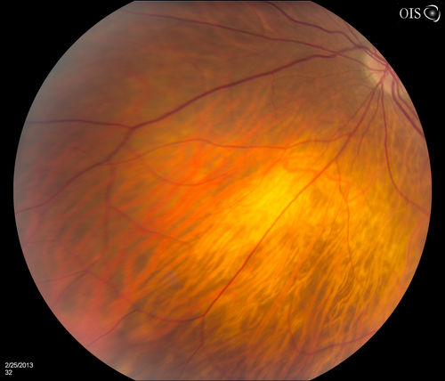 Pigmented Peripheral Retinal Degeneration
42-year old male comes in for routine eye exam and to follow up on peripheral retinal degeneration in both eyes. VA is 20/20, right eye and 20/25, left eye. Patient is asymptomatic with no visual complaints.
