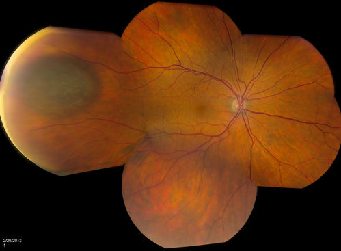 Uveal Choroidal Melanoma
Patient comes in for evaluation on a Choroidal Melanoma in the right eye. VA was 20/25 in both eyes. The melanoma is in the temporal aspect of the right eye. It measured at 0.7mm elevated after doing a BSCAN Ultrasound. 
Keywords: february2013