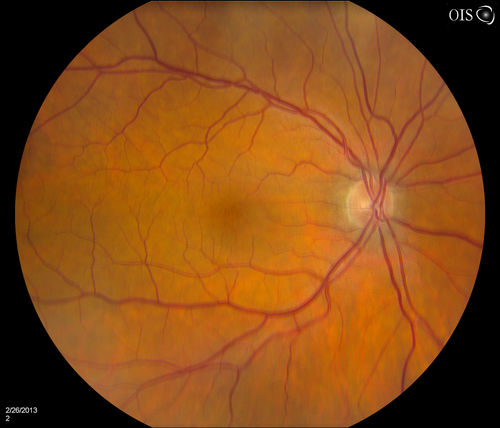 Uveal Choroidal Melanoma
Patient comes in for evaluation on a Choroidal Melanoma in the right eye. VA was 20/25 in both eyes. The melanoma is in the temporal aspect of the right eye. It measured at 0.7mm elevated after doing a BSCAN Ultrasound. 
