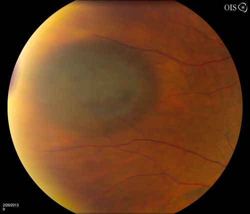 Uveal Choroidal Melanoma
Patient comes in for evaluation on a Choroidal Melanoma in the right eye. VA was 20/25 in both eyes. The melanoma is in the temporal aspect of the right eye. It measured at 0.7mm elevated after doing a BSCAN Ultrasound. 
