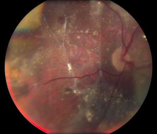 Retinal Capillary Hemangioma due to Von Hipple-Lindau Syndrome
A 47-year old female comes in for a second opinion for retinal capillary Hemangioma in the left eye. VA was HM (hand motion) in the left eye. She has had multiple procedures done for the left eye including, Retinal Detachment surgery, YAG Laser PI, YAG Laser Capsulotomy, and Cataract surgery. 
