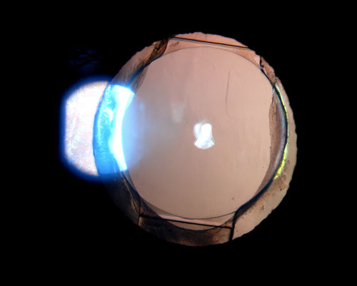 Accordioning Crystalline Lens with loss of Posterior Capsule
71-year old male complains of blurred vision in the left eye. VA 20/40, right eye and 20/400, left eye without correction. Slit lamp exam shows Crystalline lens, both eyes. Right eye IOL is aligned and centered. Left eye shows an accordion of the crystalline lens. Retro Illumination shows the IOL bent inward in the left eye. There was a 6-diopter difference of astigmatism between the right and left eye. Patient will have surgery to correct the issue. 
