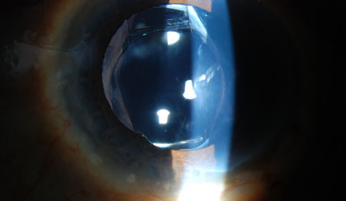 Accordioning Crystalline Lens with loss of Posterior Capsule
71-year old male complains of blurred vision in the left eye. VA 20/40, right eye and 20/400, left eye without correction. Slit lamp exam shows Crystalline lens, both eyes. Right eye IOL is aligned and centered. Left eye shows an accordion of the crystalline lens. Retro Illumination shows the IOL bent inward in the left eye. There was a 6-diopter difference of astigmatism between the right and left eye. Patient will have surgery to correct the issue. 

