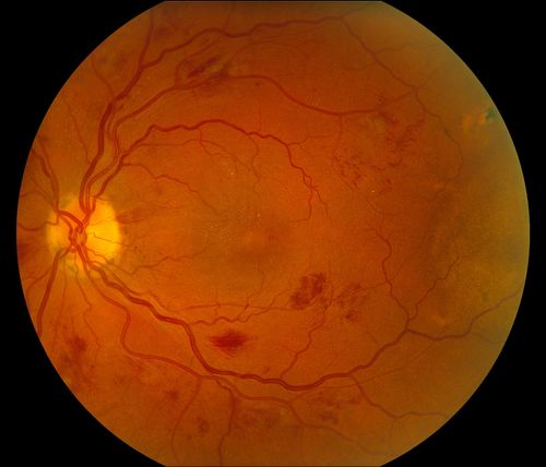 BRVO Inferiorly with Retinal Hemorrhages in the Left Eye
Patient comes in with complaint of "spot in vision", sort of a cloudy haze in the left eye. Patient's VA was 20/100-1 with no improvement with pinhole in the left eye. Fundus photos show multiple retinal hemorrhages scattered with a branch retinal vein occlusion inferiorily. Patient is also diabetic.
