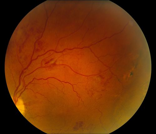 BRVO Inferiorly with Retinal Hemorrhages in the Left Eye
Patient comes in with complaint of "spot in vision", sort of a cloudy haze in the left eye. Patient's VA was 20/100-1 with no improvement with pinhole in the left eye. Fundus photos show multiple retinal hemorrhages scattered with a branch retinal vein occlusion inferiorily. Patient is also diabetic.
