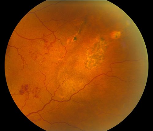 BRVO Inferiorly with Retinal Hemorrhages in the Left Eye
Patient comes in with complaint of "spot in vision", sort of a cloudy haze in the left eye. Patient's VA was 20/100-1 with no improvement with pinhole in the left eye. Fundus photos show multiple retinal hemorrhages scattered with a branch retinal vein occlusion inferiorily. Patient is also diabetic.
