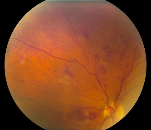 BRVO Inferiorly with Retinal Hemorrhages in the Left Eye
Patient comes in with complaint of "spot in vision", sort of a cloudy haze in the left eye. Patient's VA was 20/100-1 with no improvement with pinhole in the left eye. Fundus photos show multiple retinal hemorrhages scattered with a branch retinal vein occlusion inferiorily. Patient is also diabetic.

