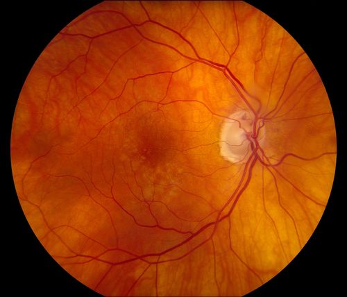 Total Dislocation of Intra Ocular Lens into the Vitreous
84-year old female comes in with blurred vision in the left eye. VA was 20/30, right eye and Count Fingers in the left eye. Fundus examination reveals dislocation of the IOL into the vitreous inferiorily @ 6-o'clock. Suggest surgery to fix the problem.  
