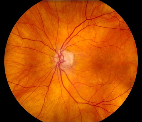 Total Dislocation of Intra Ocular Lens into the Vitreous
84-year old female comes in with blurred vision in the left eye. VA was 20/30, right eye and Count Fingers in the left eye. Fundus examination reveals dislocation of the IOL into the vitreous inferiorily @ 6-o'clock. Suggest surgery to fix the problem.  
