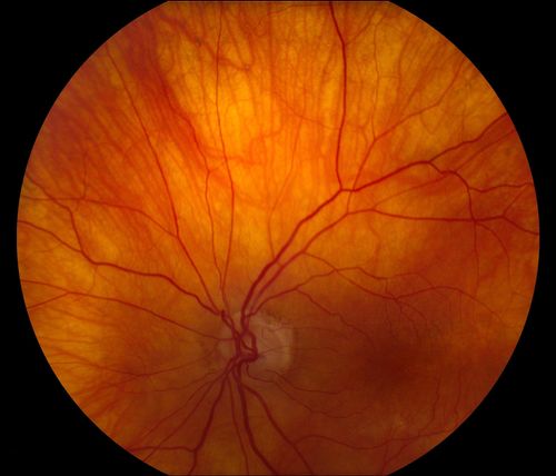 Total Dislocation of Intra Ocular Lens into the Vitreous
84-year old female comes in with blurred vision in the left eye. VA was 20/30, right eye and Count Fingers in the left eye. Fundus examination reveals dislocation of the IOL into the vitreous inferiorily @ 6-o'clock. Suggest surgery to fix the problem.  
