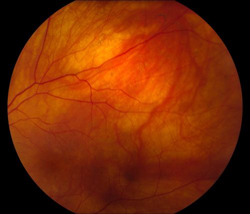 Total Dislocation of Intra Ocular Lens into the Vitreous
84-year old female comes in with blurred vision in the left eye. VA was 20/30, right eye and Count Fingers in the left eye. Fundus examination reveals dislocation of the IOL into the vitreous inferiorily @ 6-o'clock. Suggest surgery to fix the problem.  
