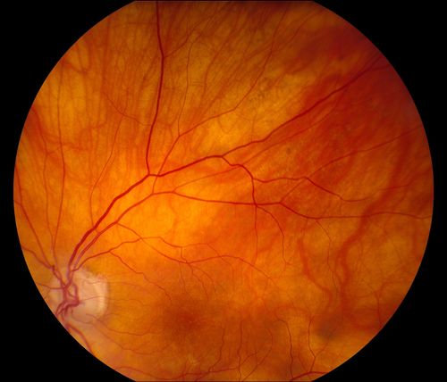 Total Dislocation of Intra Ocular Lens into the Vitreous
84-year old female comes in with blurred vision in the left eye. VA was 20/30, right eye and Count Fingers in the left eye. Fundus examination reveals dislocation of the IOL into the vitreous inferiorily @ 6-o'clock. Suggest surgery to fix the problem.  
