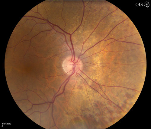 Peripheral Retinal Degeneration
Patient comes in with double vision. VA was 20/20 in both eyes. Fundus exam shows Retinal Degenerative changes in both eyes. Offer to correct double vision with temporary Fresnel prism

