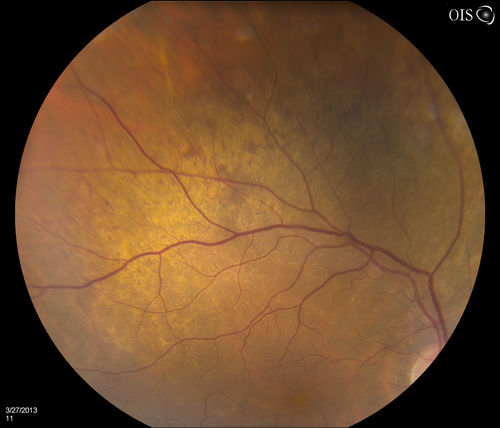 Peripheral Retinal Degeneration
Patient comes in with double vision. VA was 20/20 in both eyes. Fundus exam shows Retinal Degenerative changes in both eyes. Offer to correct double vision with temporary Fresnel prism
