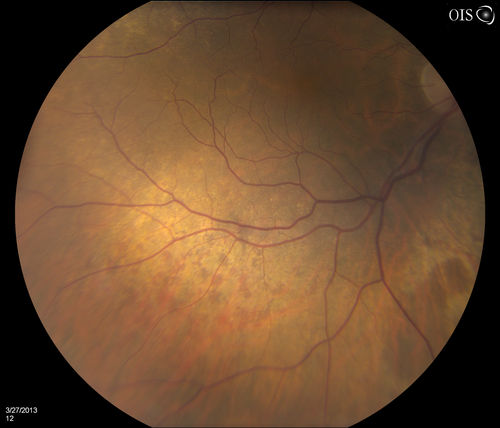 Peripheral Retinal Degeneration
Patient comes in with double vision. VA was 20/20 in both eyes. Fundus exam shows Retinal Degenerative changes in both eyes. Offer to correct double vision with temporary Fresnel prism
