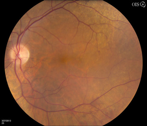 Peripheral Retinal Degeneration
Patient comes in with double vision. VA was 20/20 in both eyes. Fundus exam shows Retinal Degenerative changes in both eyes. Offer to correct double vision with temporary Fresnel prism
