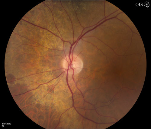 Peripheral Retinal Degeneration
Patient comes in with double vision. VA was 20/20 in both eyes. Fundus exam shows Retinal Degenerative changes in both eyes. Offer to correct double vision with temporary Fresnel prism
