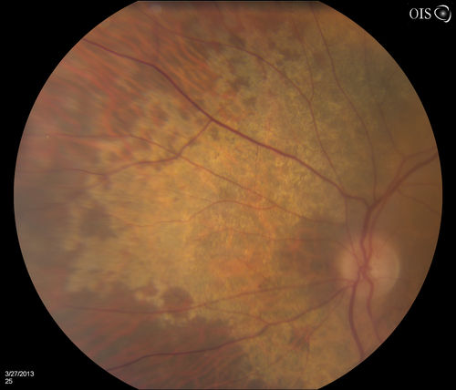 Peripheral Retinal Degeneration
Patient comes in with double vision. VA was 20/20 in both eyes. Fundus exam shows Retinal Degenerative changes in both eyes. Offer to correct double vision with temporary Fresnel prism
