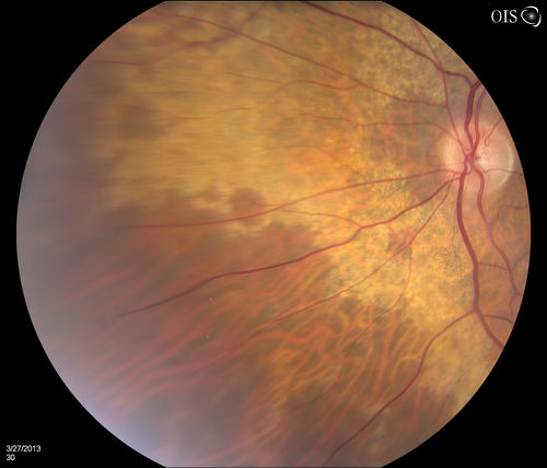 Peripheral Retinal Degeneration
Patient comes in with double vision. VA was 20/20 in both eyes. Fundus exam shows Retinal Degenerative changes in both eyes. Offer to correct double vision with temporary Fresnel prism

