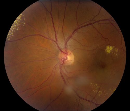 38-year old male presents with decreased vision in the left eye. VA was 20/20-right eye and 20/70-left eye with pinhole no improvement. Fundus exam shows exudates near the macula and also exudates with small hemorrhages, superior nasally in the left eye. 
