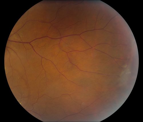 38-year old male presents with decreased vision in the left eye. VA was 20/20-right eye and 20/70-left eye with pinhole no improvement. Fundus exam shows exudates near the macula and also exudates with small hemorrhages, superior nasally in the left eye. 
