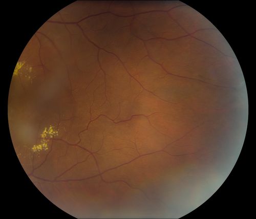 38-year old male presents with decreased vision in the left eye. VA was 20/20-right eye and 20/70-left eye with pinhole no improvement. Fundus exam shows exudates near the macula and also exudates with small hemorrhages, superior nasally in the left eye. 
