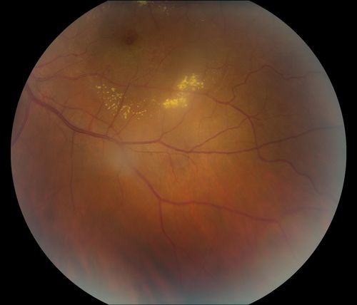 Coates' Disease
38-year old male presents with decreased vision in the left eye. VA was 20/20-right eye and 20/70-left eye with pinhole no improvement. Fundus exam shows exudates near the macula and also exudates with small hemorrhages, superior nasally in the left eye. 
